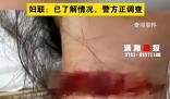 女子稱孕期遭家暴被丈夫拿刀割脖子 目前警方正在調(diào)查處理