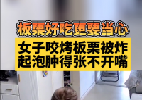 女子吃烤栗子被炸嘴腫得張不開 商家顧客都有點虎