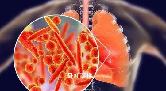 肺炎支原體感染迎來高峰?醫生回應
