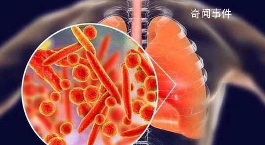 支原體肺炎有后遺癥嗎?專家回應