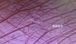 女孩外地求醫 切開闌尾有蟲子游出