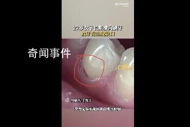 27歲女子長期橫向刷牙致牙齒缺損
