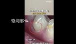 27歲女子長期橫向刷牙致牙齒缺損