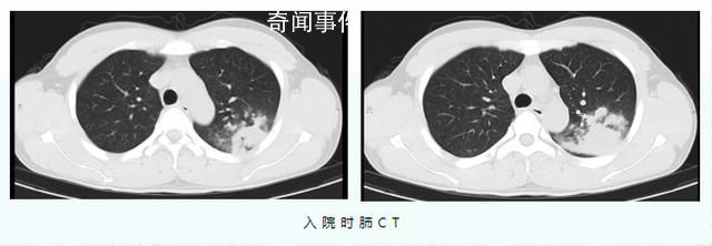 醫生:支原體肺炎成人也會中招 成人患者較以往增多