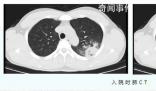 醫(yī)生:支原體肺炎成人也會中招 成人患者較以往增多