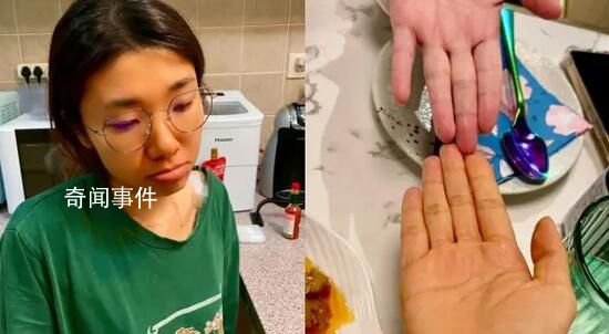 女子為減肥連吃3月胡蘿卜變小橘人