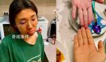 女子為減肥連吃3月胡蘿卜變小橘人