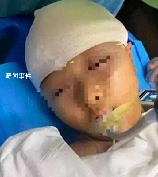 被打破頭骨女孩已出院 或有后遺癥