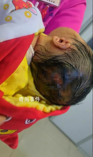 出生4天新生兒被護士燙傷頭部 目前孩子的傷口基本愈合了