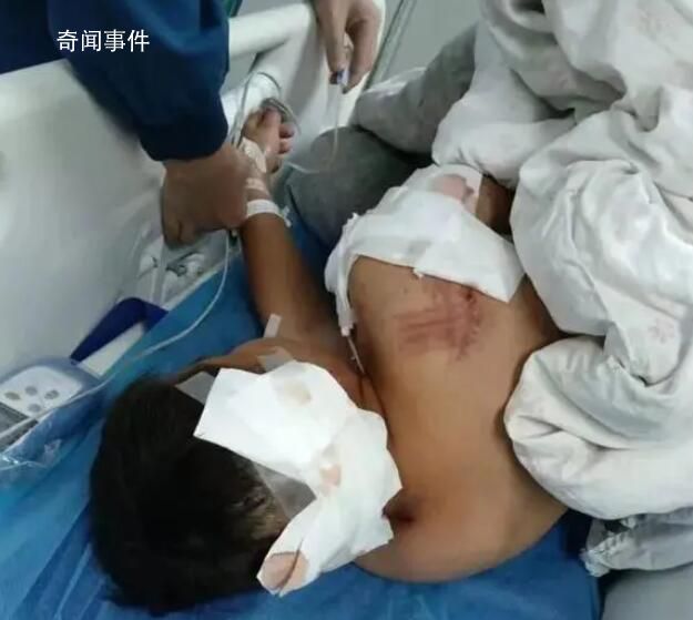 男童遭阿拉斯加犬咬傷 仍在ICU救治