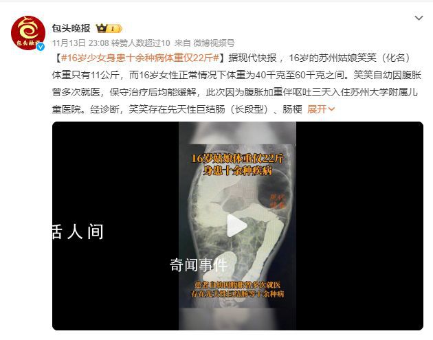 16歲少女患十余種病體重22斤