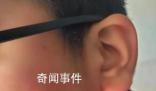 疑因算錯題小學生被老師打耳光 致視力嚴重受損