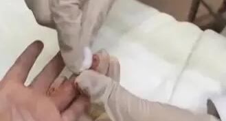 醫生給孩子采血手套殘留他人血跡 引發網友關注