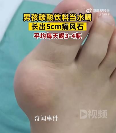 男孩1天4瓶飲料長5厘米痛風石 目前患者恢復良好