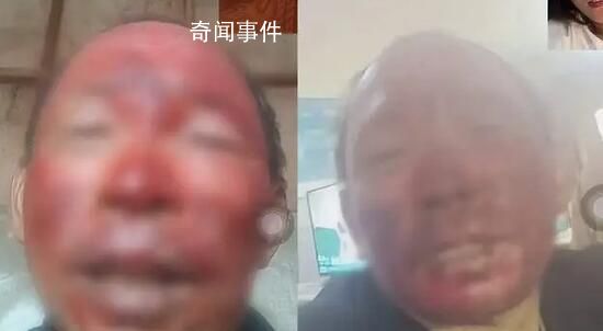 女婿去世女兒住院 男子燒傷不舍就醫