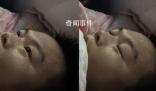 男子同時患甲流支原體燒到額頭冒煙 網友：這下CPU要被干燒了