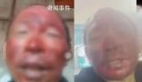 女婿去世女兒住院 男子燒傷不舍就醫