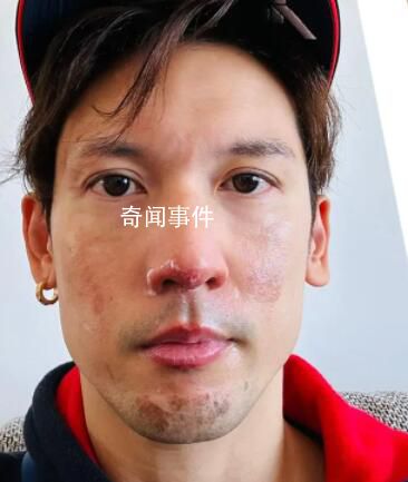港星關智斌面部手部二級燒傷 面部和嘴唇變得紅腫