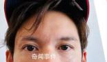 港星關智斌面部手部二級燒傷 面部和嘴唇變得紅腫