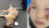 8歲男童遭狗撲咬 臉上縫了90多針