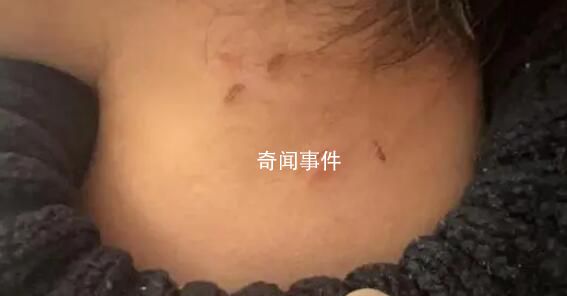 家長稱孩子遭老師虐待 身上都是摳痕