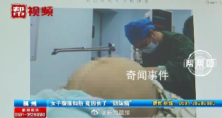 23歲女子腹脹如鼓取出42斤腫瘤