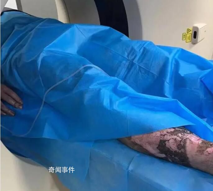 大學生爬火車拍照被燒傷進ICU 全身50%燒傷