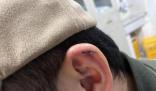 小伙理發(fā)時耳朵被剪縫六針 雙方?jīng)Q定等拆線后據(jù)傷情再協(xié)商