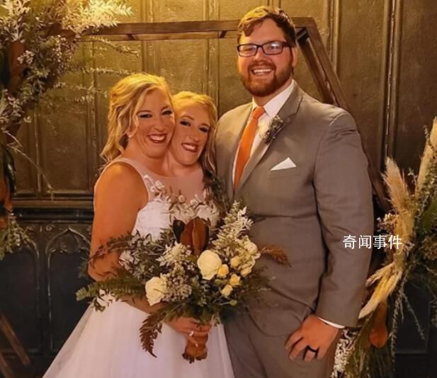 美國連體雙胞胎姐妹其中一人已婚